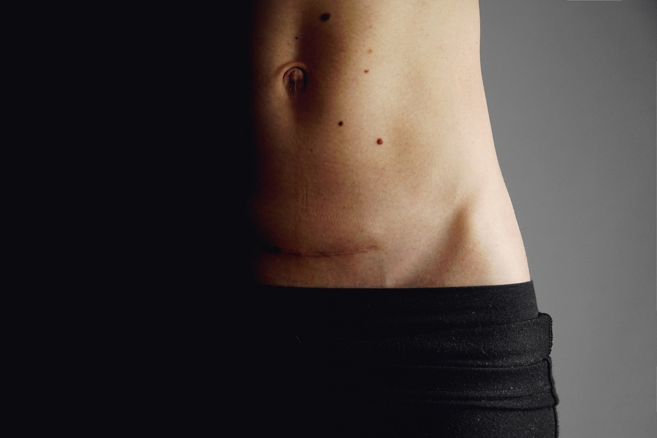 Barriga Estirada No Pos Parto Pode Ser Problema De Saude A Diastase Abdominal